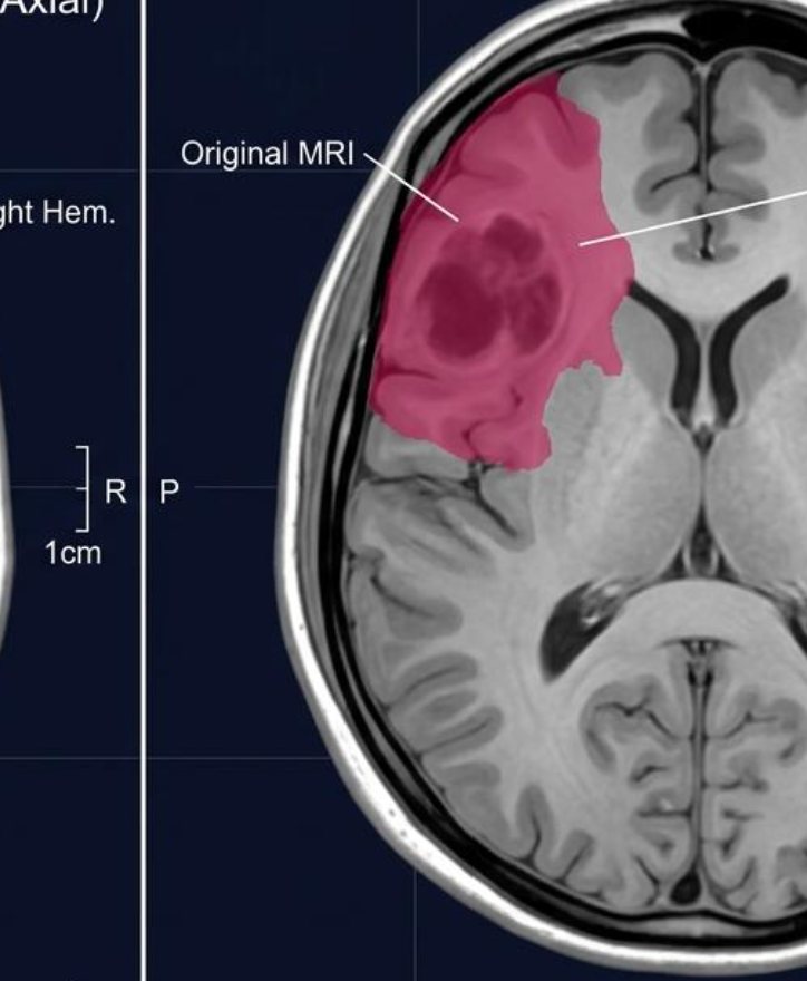 Illustrative annotated axial brain MRI visualization; supplied reference concept, not verified model output