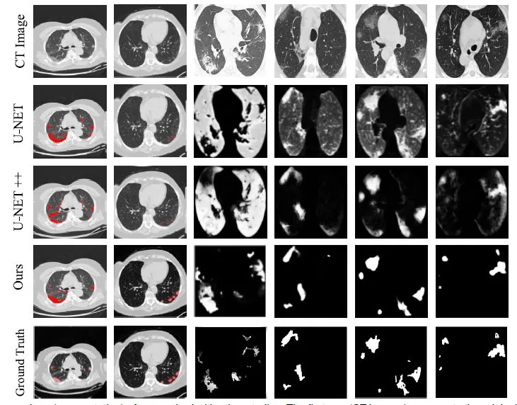 AI Assists Real-Time CT Scan Analysis