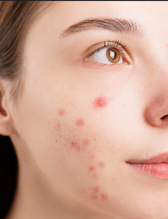 Acne-Prone Skin